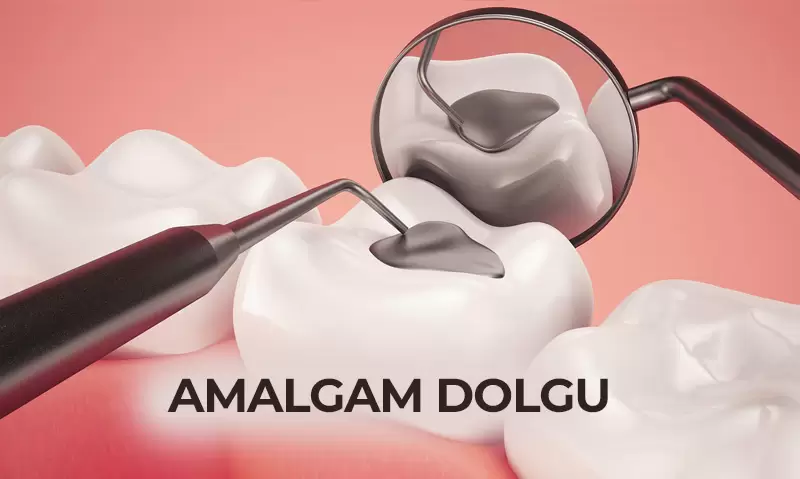 Amalgam Dolgu Nedir? Zararları ve Yararları