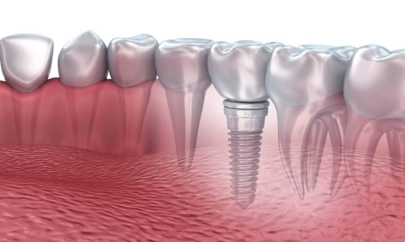 İmplant Bakımı Nasıl Olmalıdır?