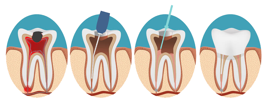 Kanal Tedavisi Kanal Tedavisi