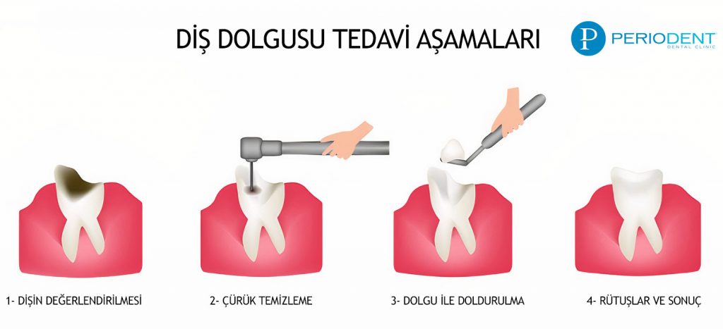 Diş Dolgu Fiyatları Diş Dolgu Fiyatları