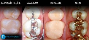 diş dolgusu diş dolgusu