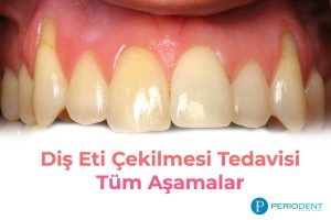 diş eti çekilmesi tedavisi diş eti çekilmesi tedavisi