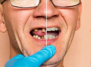 teeth implants in turkey