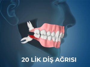 20 lik diş ağrısı nasıl geçer