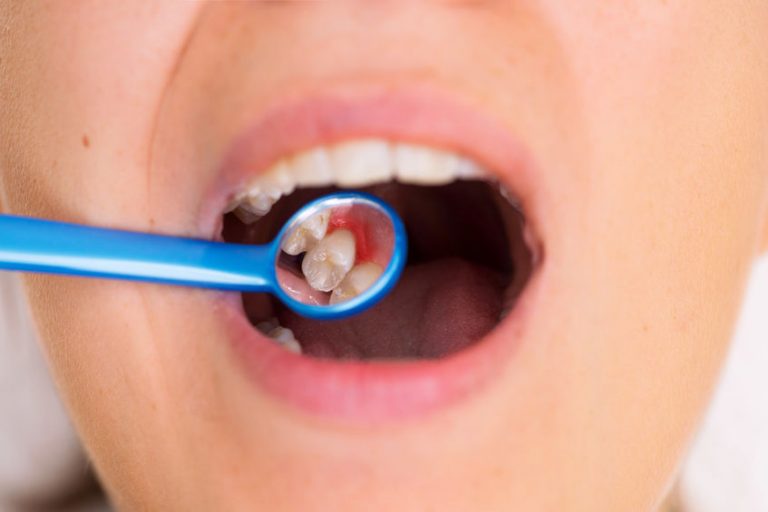 diş eti çekilmesi tedavisi nasıl yapılır