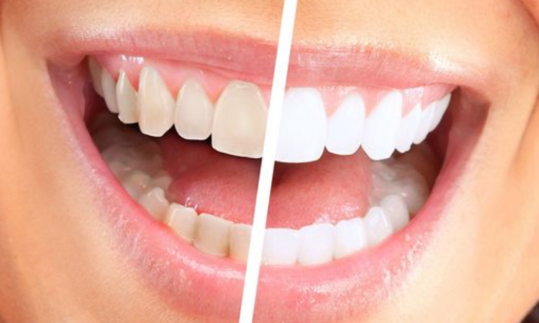 evde diş beyazlatma Periodent