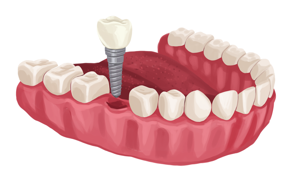İmplant Mı? Protez Diş Mi? Hangisini Tercih Etmeliyiz?