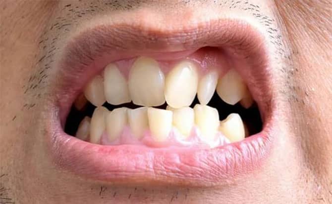 Yamuk Diş Nedir? Yamuk Diş Düzeltme Fiyatları 2021