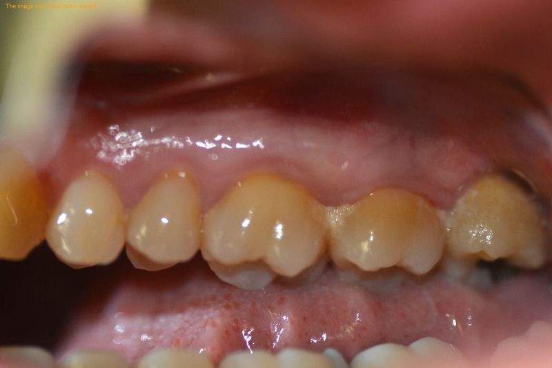 Diş Eti Hastalığı Tedavisi