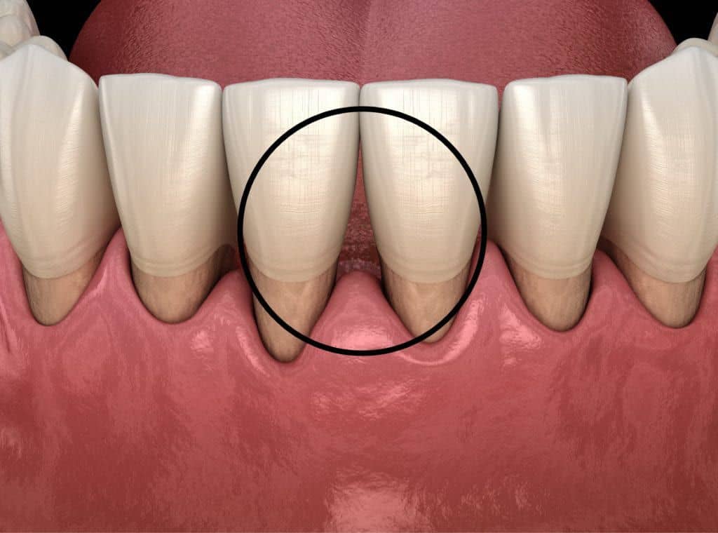 Diş Eti Çekilmesi Tedavisi Nasıl Yapılır? Periodent