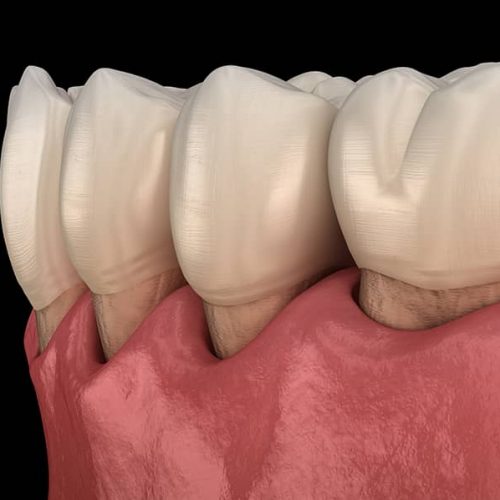 Diş Eti Çekilmesi Tedavisi Nasıl Yapılır? Periodent