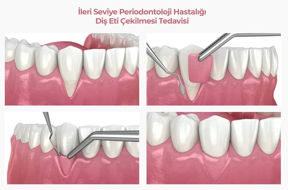 Periodontoloji Nedir? Periodontoloji Tedavisi
